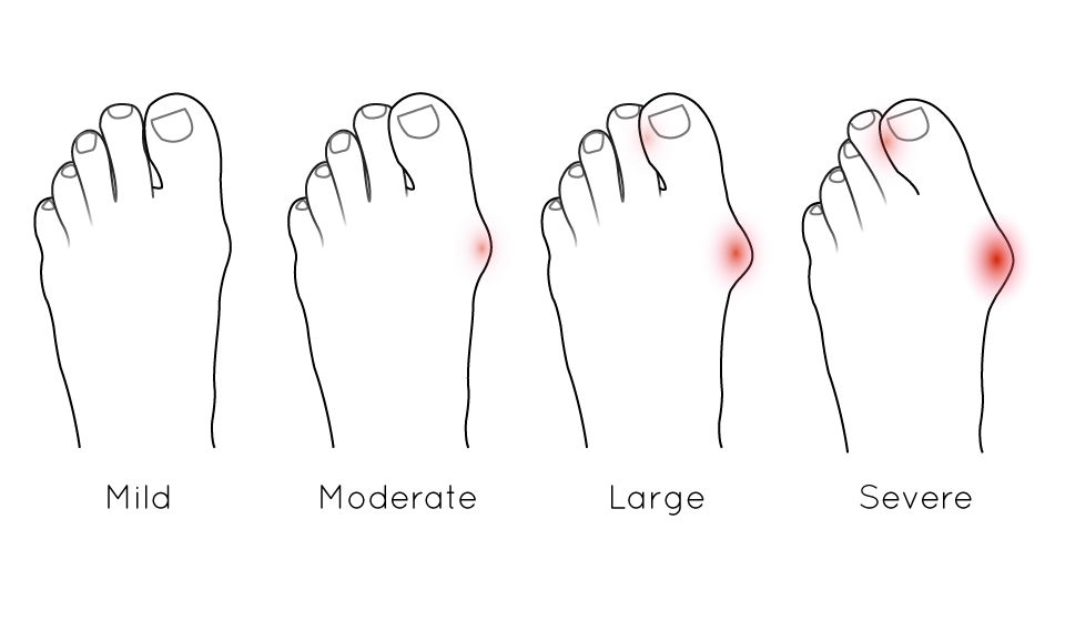 bunion severity examples
