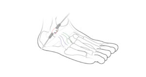 Ankle Injury Surgery